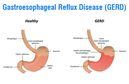 Read more about the article Gastroesophageal reflux disease (GERD)