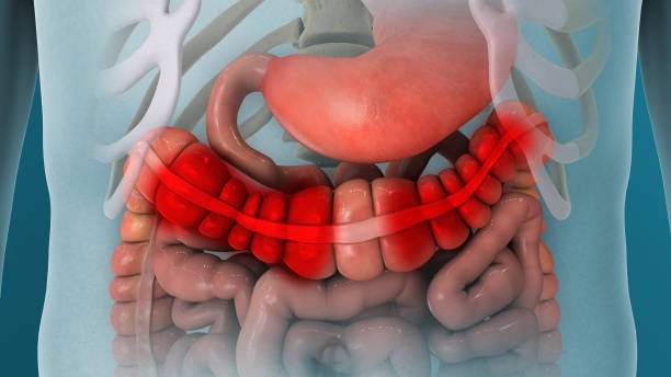 Read more about the article Causes and Treatment of IBD, Ulcerative Colitis, and Crohn’s Disease