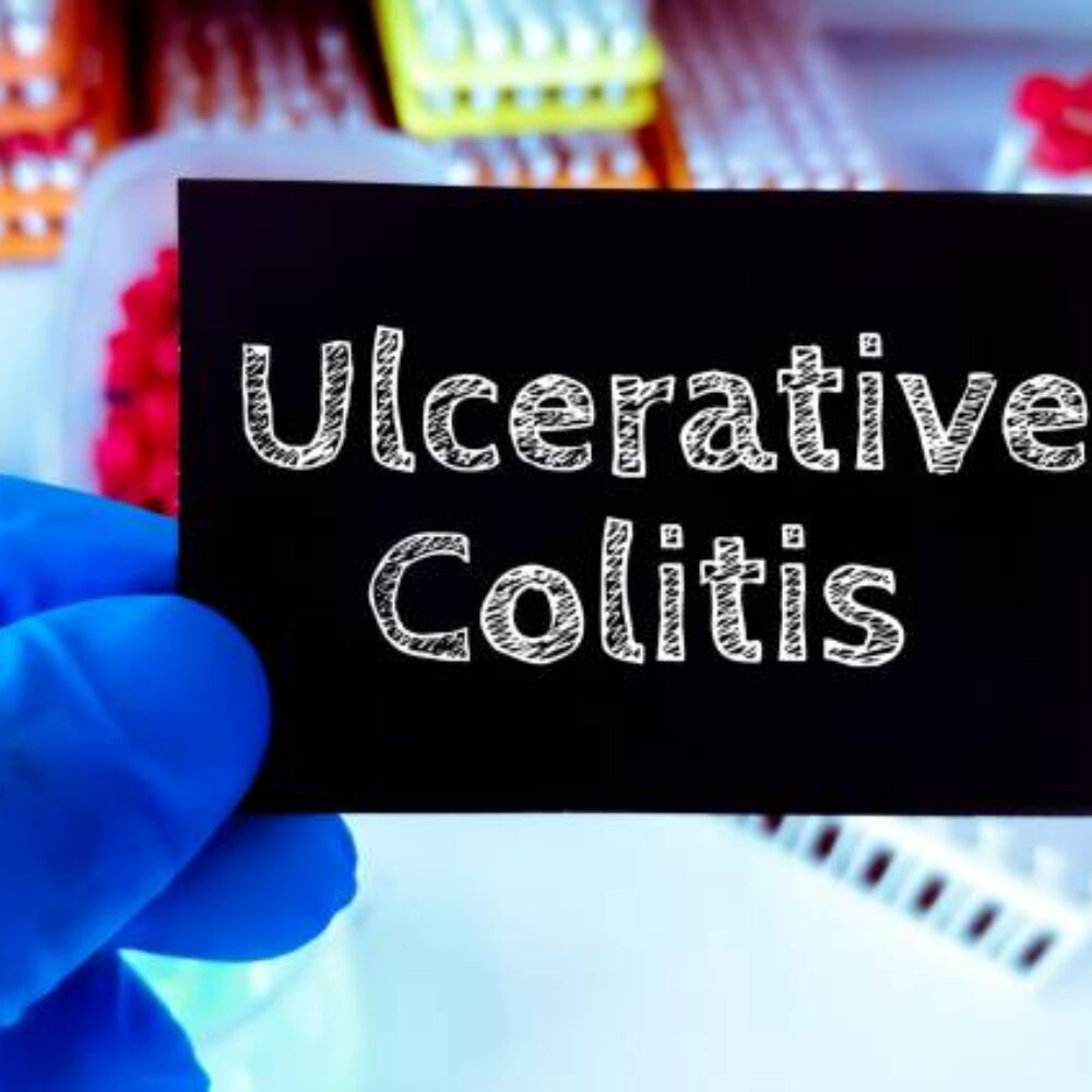 Ulcerative Colitis: Foods to eat and avoid with ulcerative colitis